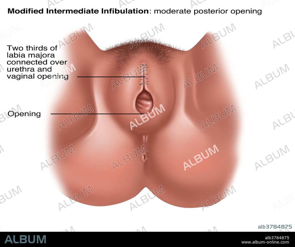 Modified Infibulation, Illustration