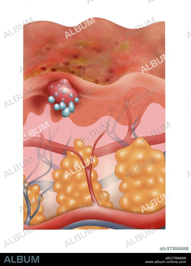 Cross-section illustration of the sub-acute stage of eczema on the skin. During the sub-acute phase, the rash transitions from acute to chronic becoming flakey. Topical steroids and ointments are used to ease the discomfort of the eczema rash.