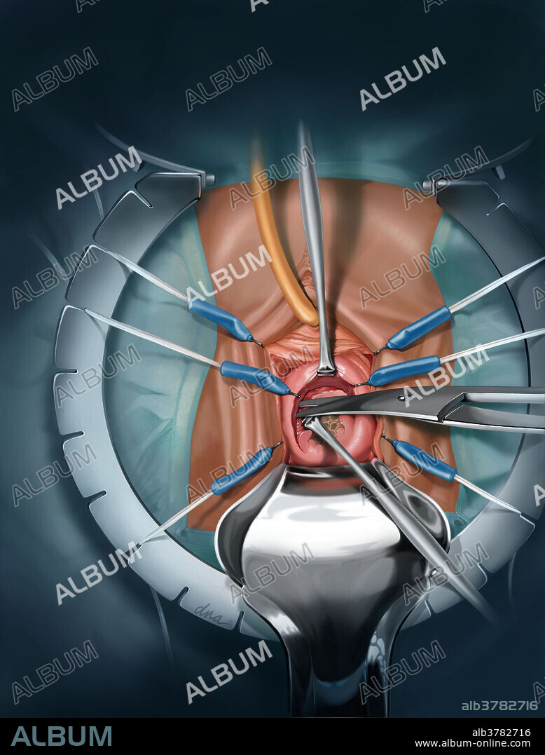 Illustration showing repair of vaginal mesh extrusion after pelvic organ prolapse surgery with sling.