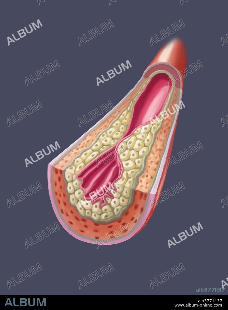 A clogged artery or Atherosclerosis (arteriosclerotic vascular disease - ASVD) is when the artery walls thicken due to the buildup of cholesterol. The accumulation of multiple plaques can lead to strokes and cardiac arrest often without any prior symptoms.