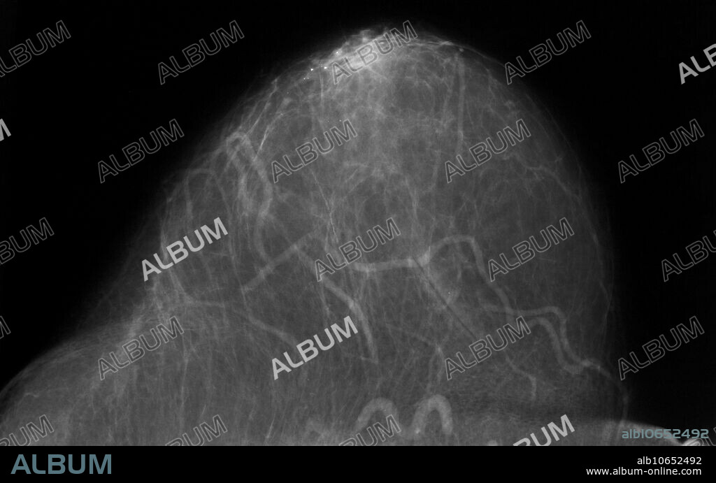Mammogram showing benign calcifications.