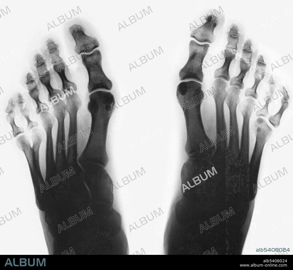 X-ray of feet, showing postaxial polydactyly. Polydactylism is the congenital abnormality of having extraneous fingers or toes. As visible above, this individual had six toes on both feet. This is an example of postaxial polydactyly, because the extra digit occurs on the pinky side of the foot.