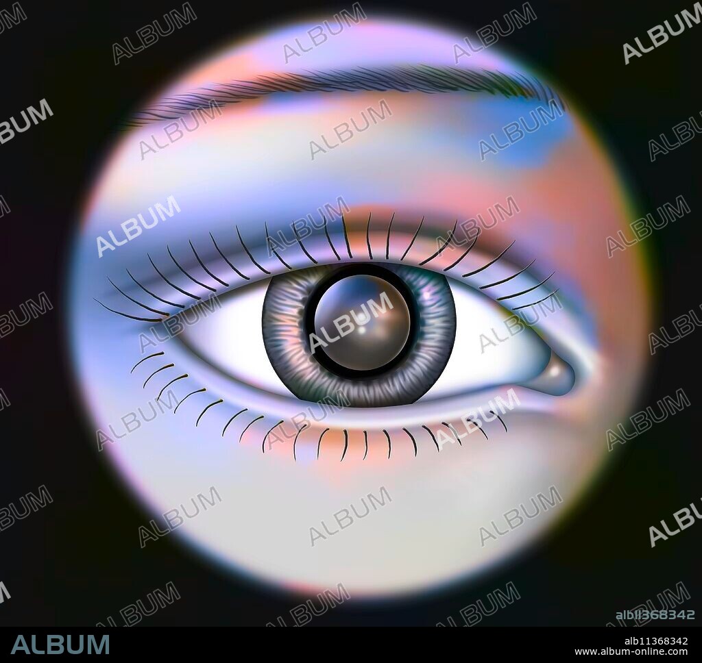 Eye: Implant permanently placed in the anterior chamber.