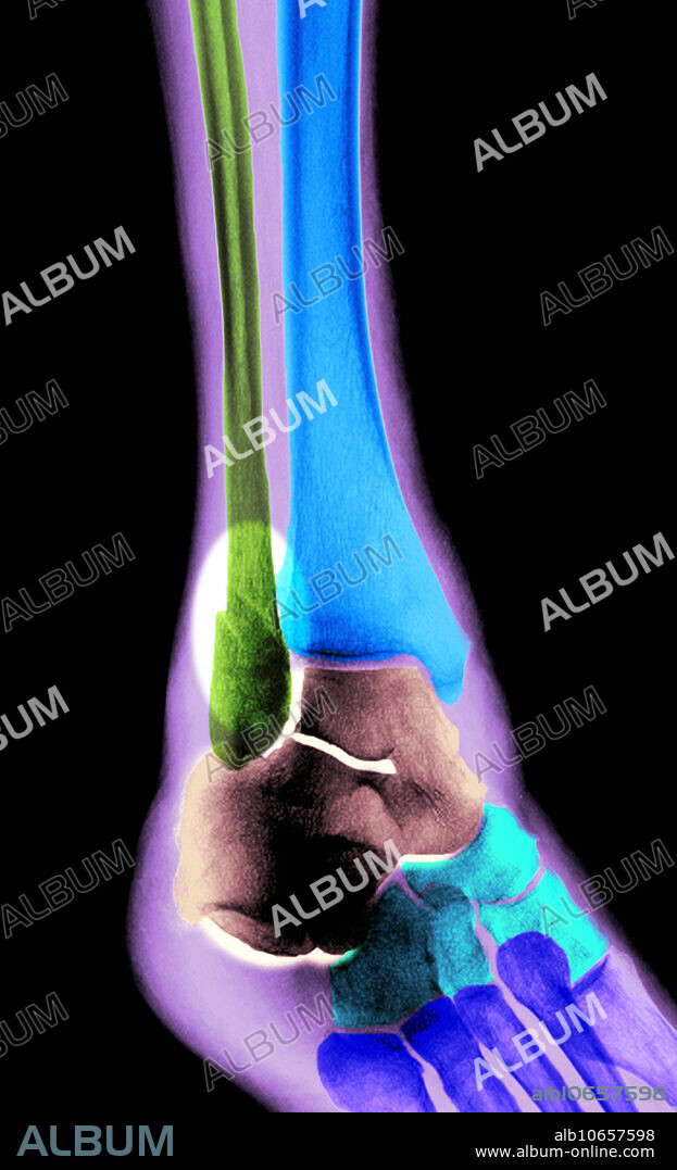 colour-enhanced x-ray of an ankle fracture, with an oblique oriented fracture of the distal fibula (green) and associated soft tissue swelling, secondary to the injury.