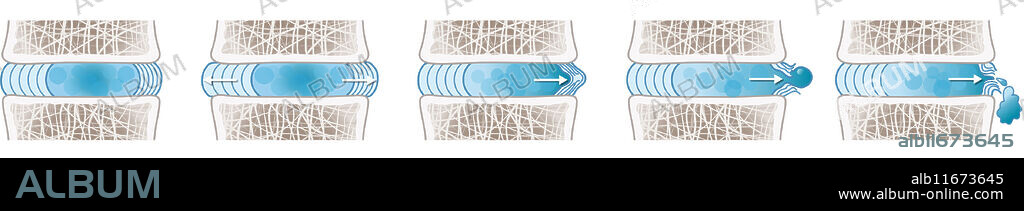 Herniated disc schema. Normal. Bulge. Protusion. Extrusion. Sequestration. Illustration.
