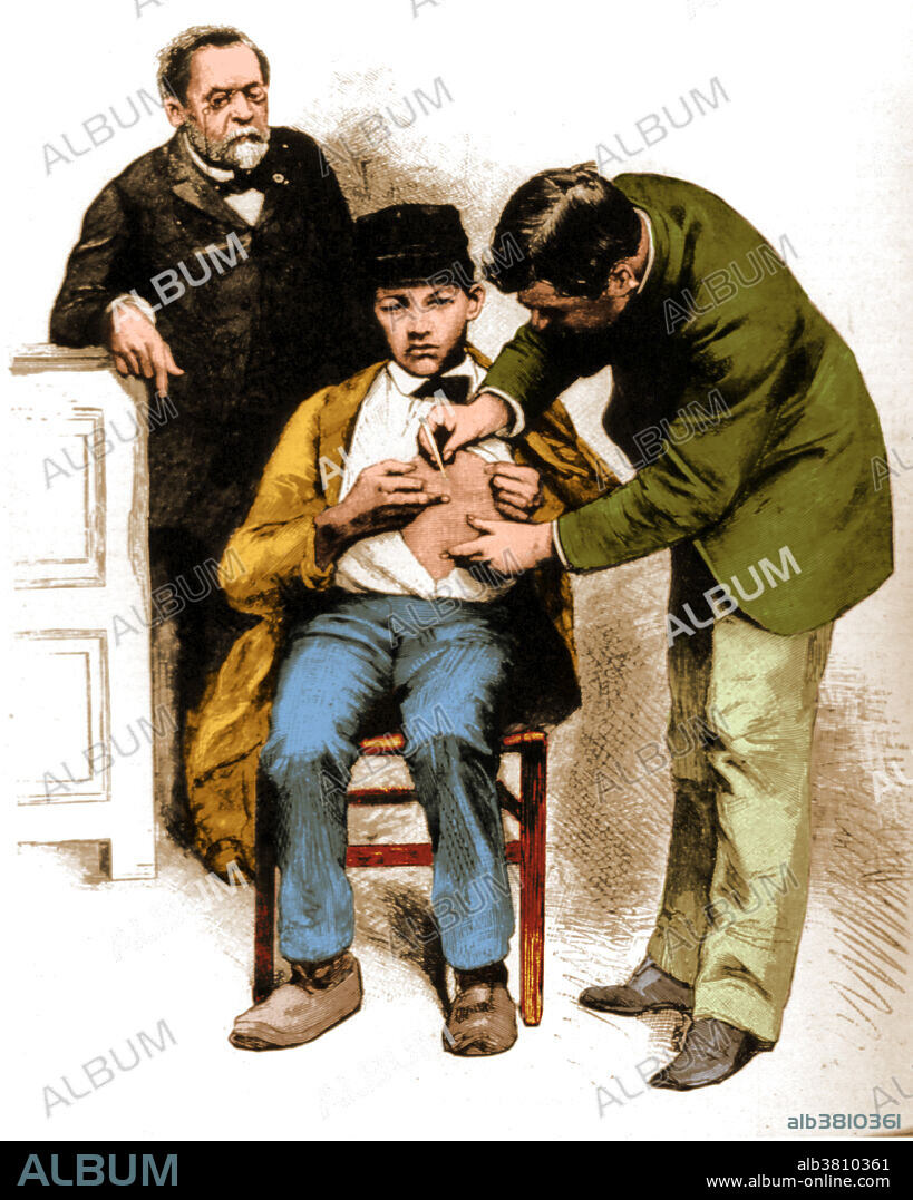 Louis Pasteur observes a young boy receiving an inoculation for hydrophobia (rabies). Louis Pasteur (December 27, 1822 - September 28, 1895) was a French chemist and bacteriologist who founded the science of microbiology. Pasture discovered that disease could be caused by bacteria transmitted from person to person (the germ theory of disease). He also developed vaccines for rabies and anthrax. Pasteur also found that lightly heating food and beverages could preserve them from souring. This pasteurization process is now widely used in the food industry. As a chemist, Pasteur discovered that some crystals had two forms, one which would rotate plane-polarized light to the left, and the other would rotate light to the right. This led to the study of stereochemistry. In 1887 he founded the Pasteur Institute.