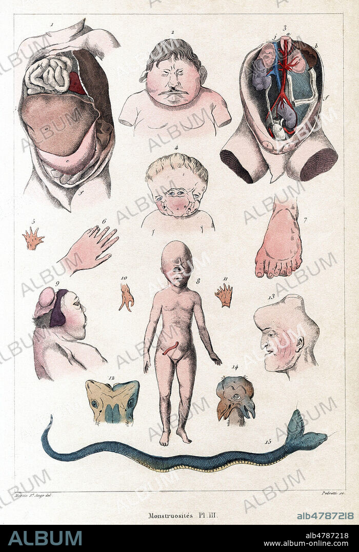 Monstruosites. (Corps de bebe ou d'animaux mal formes a la naissance). Planche anatomique illustree par Gaspard Joseph MARTIN-SAINT-ANGE (1803-1888) vers 1835 pour Des monstres, de leurs causes et de leurs variétés de Gabriel GRIMAUD de CAUX (1800-1881). Credit : Collection Jonas/Kharbine-Tapabor.