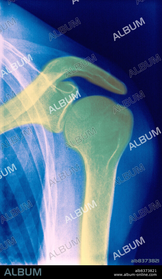 Colorized x-ray of a normal shoulder.. The shoulder joint is the articulation connecting the arm to the thorax. The head of the humerus is articulated with the scapula posteriorly and the clavicle anteriorly. Three zones can be described: the deltoid region (the shoulder cuff), the axillary region (armpit), and the scapular region. The shoulder joint is a highly mobile articulation enabling a wide range of arm movements. This is a colored x-ray of a normal shoulder.