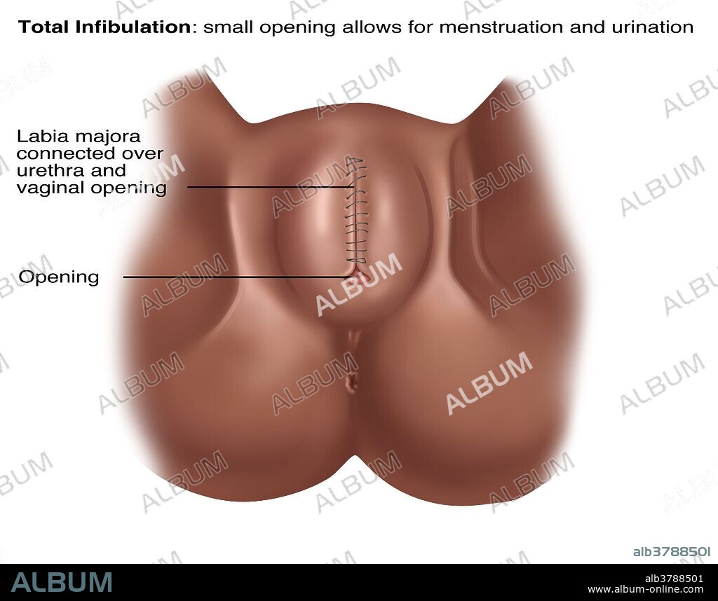 infibulation Female Circumcision: Management of Urinary Complications