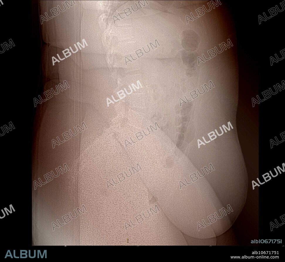 This colour-enhanced lateral (from the side) X-ray of a person with morbid obesity shows the extensive redundancy of skin folds and fat deposition. The difficulty in seeing the underlying bones is related to the attenuation of the X-ray beam from the excess soft tissue.