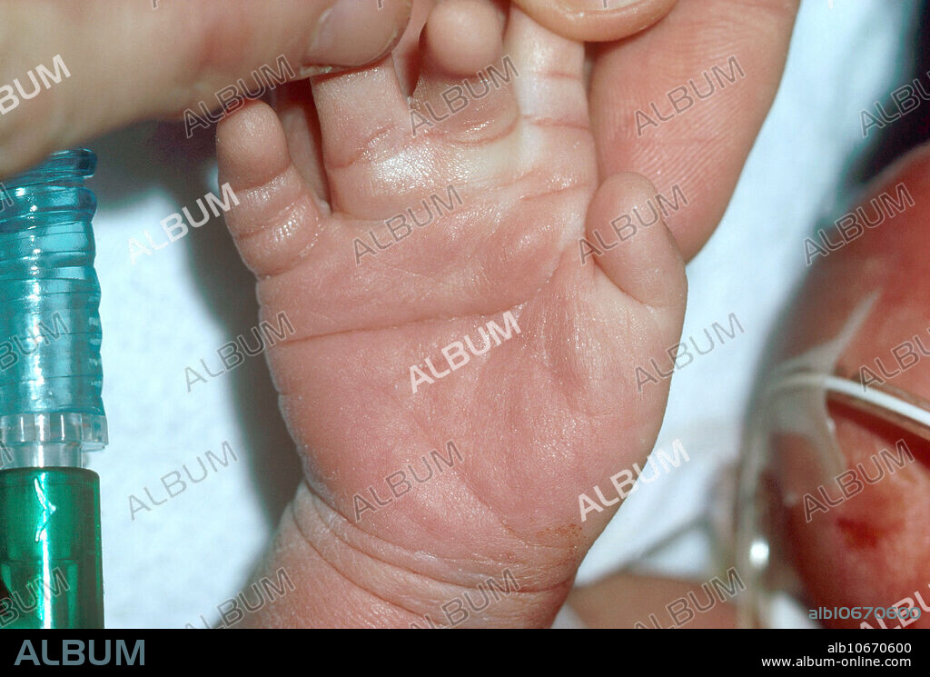 A single transverse palmar crease, also known as a simian crease or simian line. This can be a symptom associated with abnormal medical conditions.