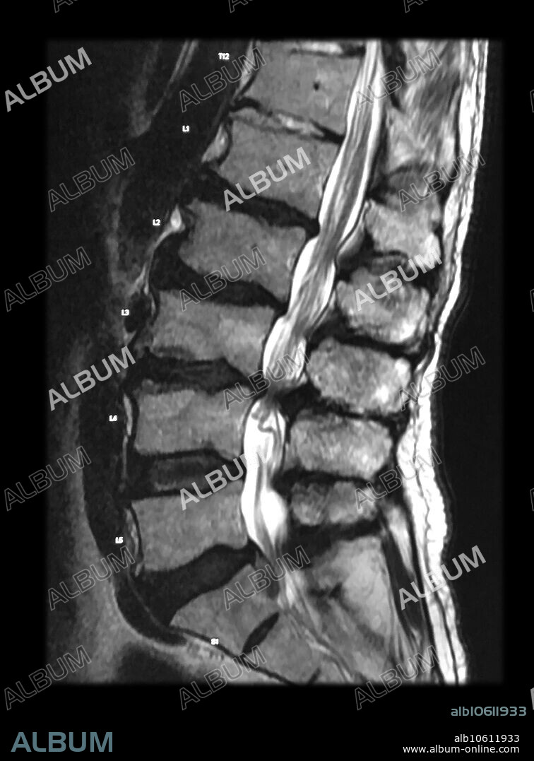 MRI Spinal Stenosis
