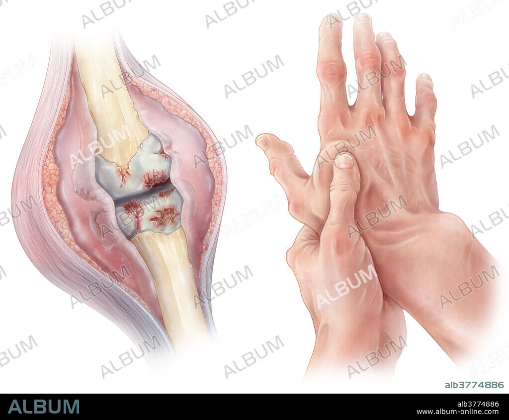 An illustration depicting rheumatoid arthritis, an autoimmune inflammatory disease which primarily affects joints, yet can spread to other areas of the body such as the heart or lungs. Abnormal interactions between white blood cells initiates an autoimmune response against healthy tissue, promoting the inflammation of synovial joints. As a result, excess synovial fluid containing white blood cells, cytokines and antibodies, begins collecting in the joint cavity. As the disease progresses, the synovial membrane surrounding the joint begins to thicken as cartilage and bone are gradually eroded. This can eventually lead to pain, limited movement or deformity of the joint, while also leading to fever or fatigue. Rheumatoid arthritis is more common in during.