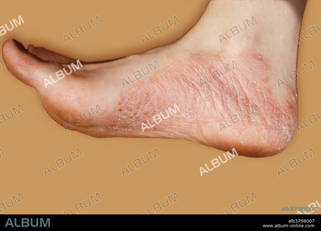 Psoriatic plaque on female foot. Psoriasis is a chronic skin disease, occurring in about 1% of adults, characterized by itchy, scaly patches (psoriatic plaques). For reasons unknown, the body exhibits a ten-fold increase in the rate of new skin production.