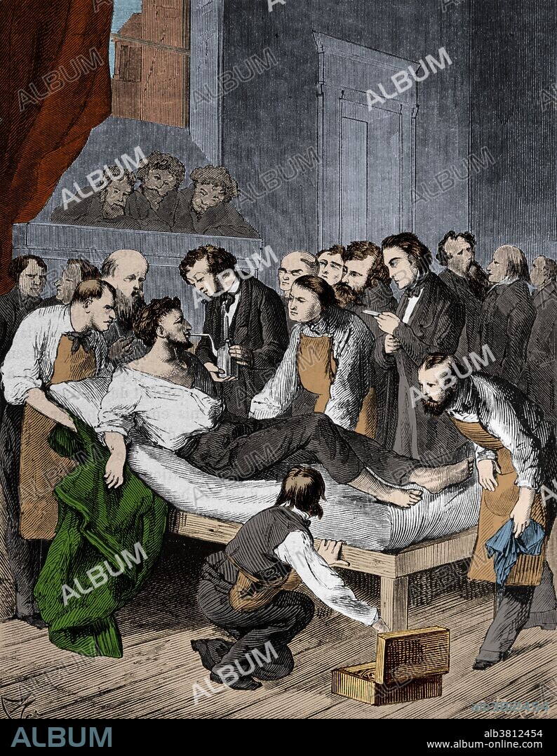 Engraving showing doctors administering sulphuric ether to a patient prior to removing a tumor from his neck in 1846, marking the first operation done under anesthesia. This image has been color enhanced.