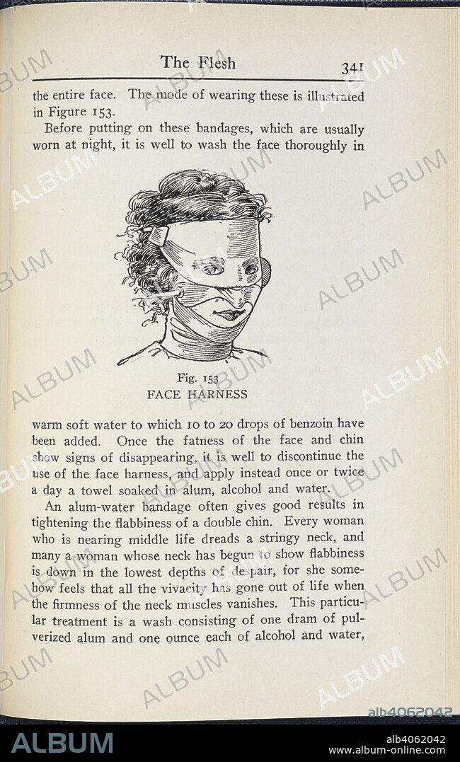 WILLIAM A WOODBURY. 'Face harness.'. Beauty Culture. A practical handbook on the care of the person, designed for both professional and private use ... Profusely illustrated. London; New York [printed] : T. Fisher Unwin, 1911. Source: 7406.ee.4 page 341 figure 153.