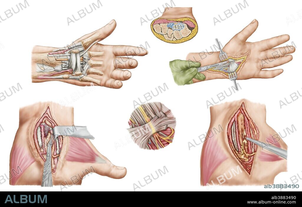Medical illustration showing carpal tunnel syndrome in the human wrist, and the surgical procedures associated with it.