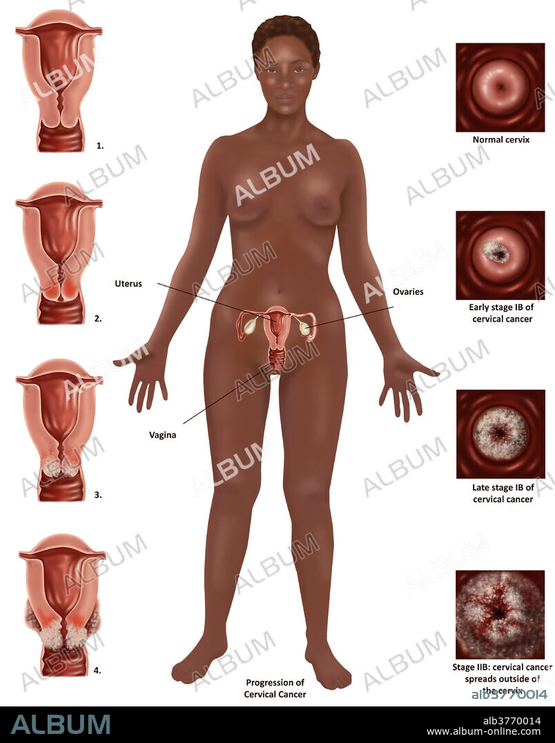 Illustration showing the progression of cervical cancer. Symptoms of cervical cancer include bleeding between periods, pain after sexual intercourse and heavier periods. Cancer of the cervix is rare and if detected early is almost always cured.