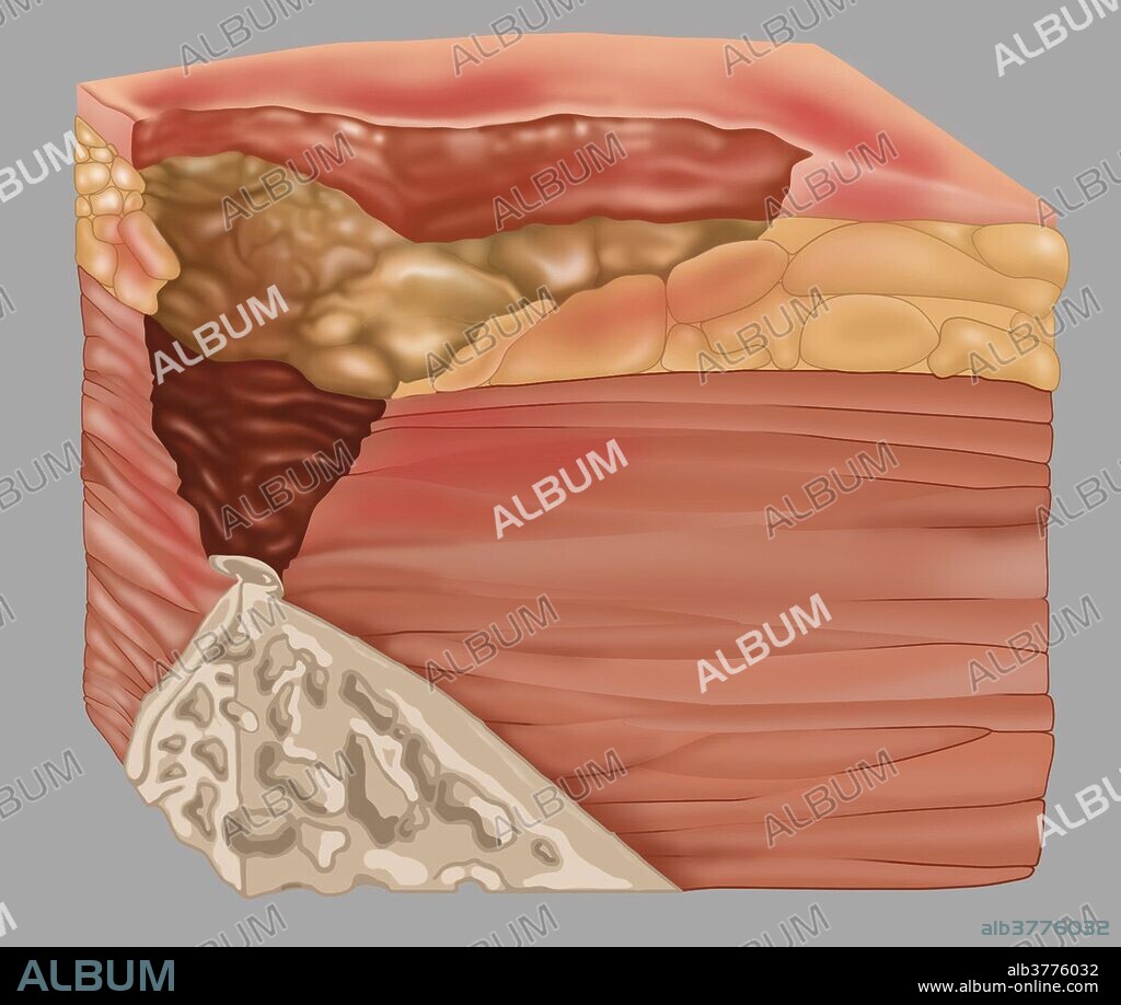 Stage 4 of a bedsore. Bedsores can be caused by many factors including unrelieved pressure, friction, humidity, etc. Bedsores usually afflict the frail and elderly, wheelchair bound people and the terminally ill. Bedsores can be fatal but can be treated and cured by a regimen of relieving pressure by turning the body on a strict schedule.