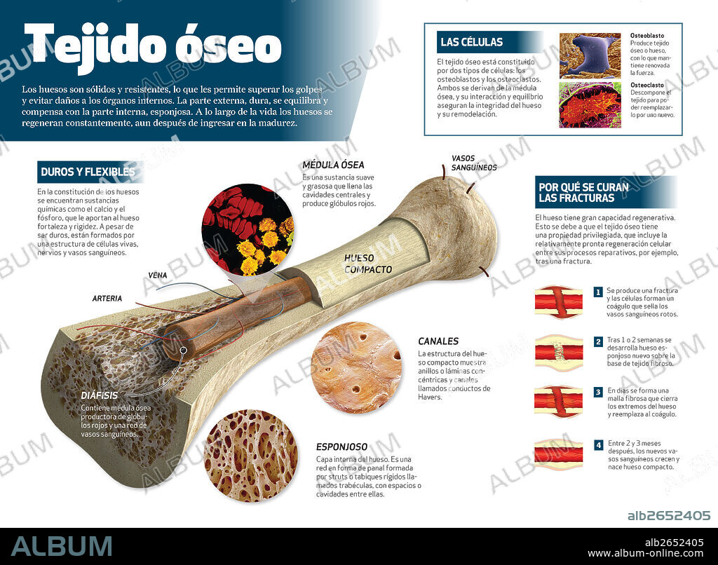 tejido óseo. Infografía del tejido óseo. Estructura del hueso y detalle del por qué se curan las fracturas.