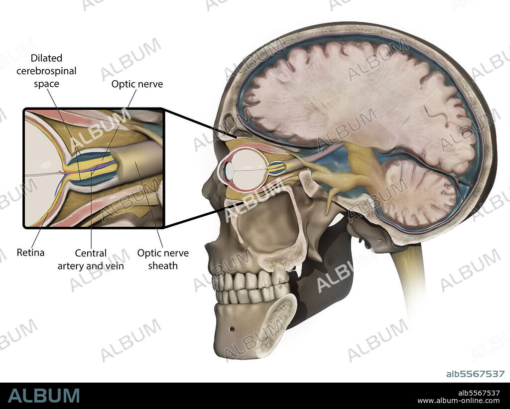 Medical illustration depicting swelling of the optic nerve (papilledema) caused by increased intracranial pressure.