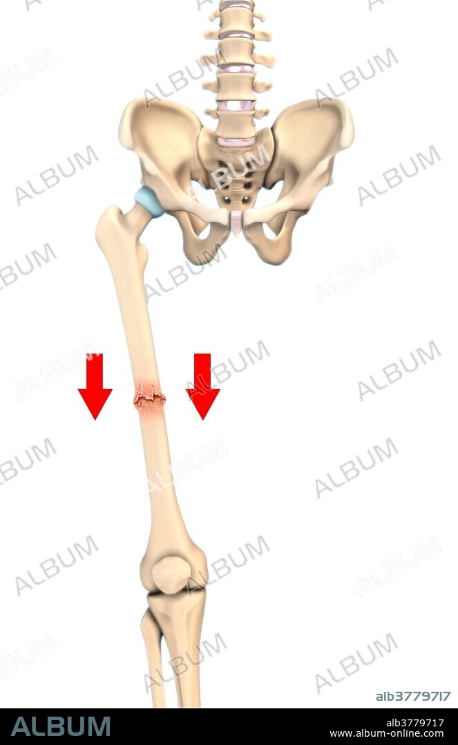 An illustration of an impacted fracture in which bone fragments are driven into each other.