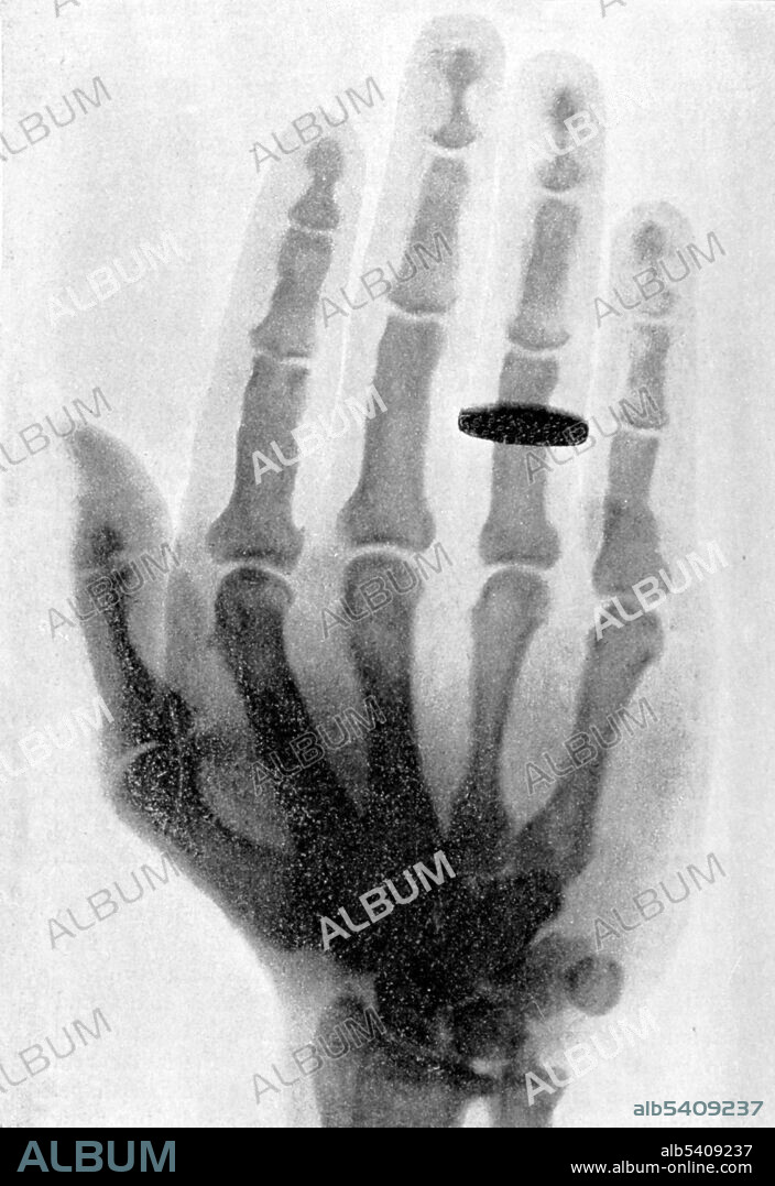 X-ray of subject with acromegaly. Acromegaly is a disorder that results from excess growth hormone after the growth plates have closed.  The initial symptom is typically enlargement of the hands and feet. There may also be enlargement of the forehead, jaw, and nose. Other symptoms may include joint pain, thicker skin, deepening of the voice, headaches, and problems with vision. Acromegaly is typically due to the pituitary gland producing too much growth hormone.  Acromegaly by Maximilian Sternberg, 1899 (cropped and cleaned).
