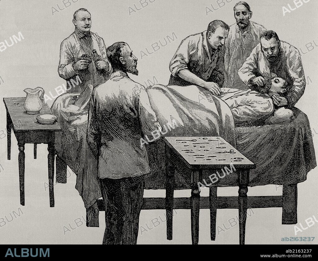 HISTORIA DE LA MEDICINA. ANESTESIA mediante CLOROFORMO, producto que se empezó a utilizar como anestésico general en el año 1847. Grabado del siiglo XIX.