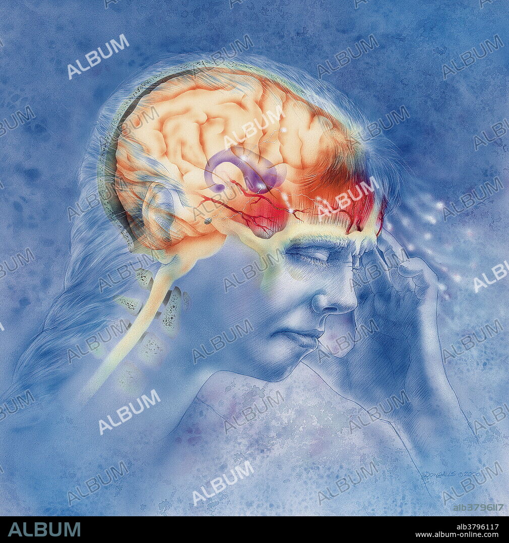 Migraine. Conceptual artwork of a person suffering from a migraine headache. A migraine is a recurrent headache that can be accompanied by nausea, vomiting and sensitivity to light and sound. These symptoms are caused by changes in brain activity which produce inflamed blood vessels (red) and nerves around the brain (orange). The areas particularly affected are the frontal and temporal lobes of the brain. The exact cause is unknown, but triggers that provoke an attack include certain foods, stress and anxiety, and too little or too much sleep. Migraines cannot be cured, but triggers should be avoided and the symptoms treated.