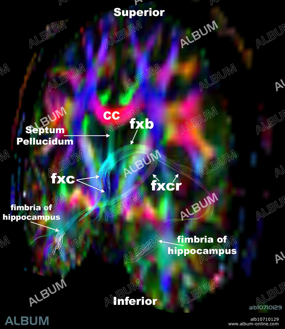 Fornix, hippocampus and mammillary body colour tractography. This oblique (angled) coronal (frontal) plane colour DTI image provides information and depiction of the major white matter tracts in the brain. By convention tracts oriented from anterior to posterior (front to back) are green, tracts oriented from side to side are red and those tracts oriented superior to inferior (head to toe) are blue. fxc = columns of fornix, fxb = body of fornix, fxcr = crura of fornix, mb = mammillary body, ac = anterior commissure, cc = corpus callosum.
