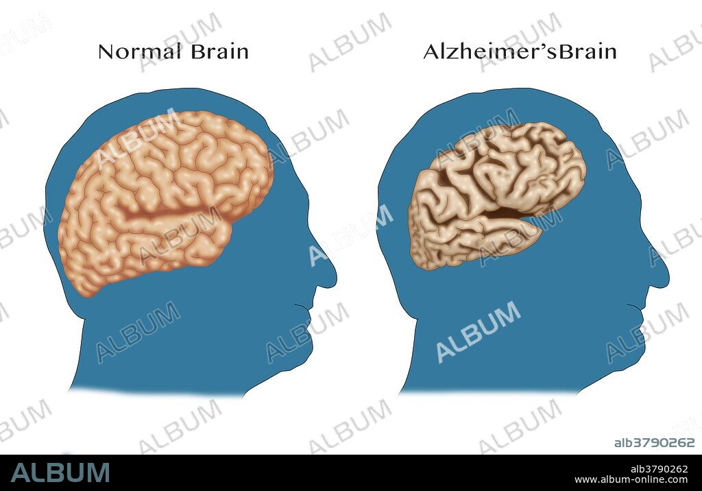 Illustration comparing a normal brain (left) with a brain suffering from Alzheimer's disease (right).