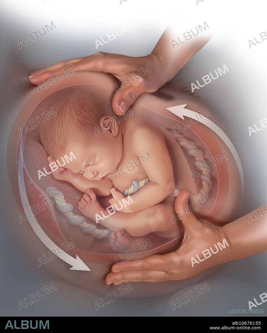 ECV (external Cephalic Version) in use to try and avoid Caesarean section on a mother with a foetus in complete breech presentation. The baby is lifted out of the pelvic cavity and rotated head down.