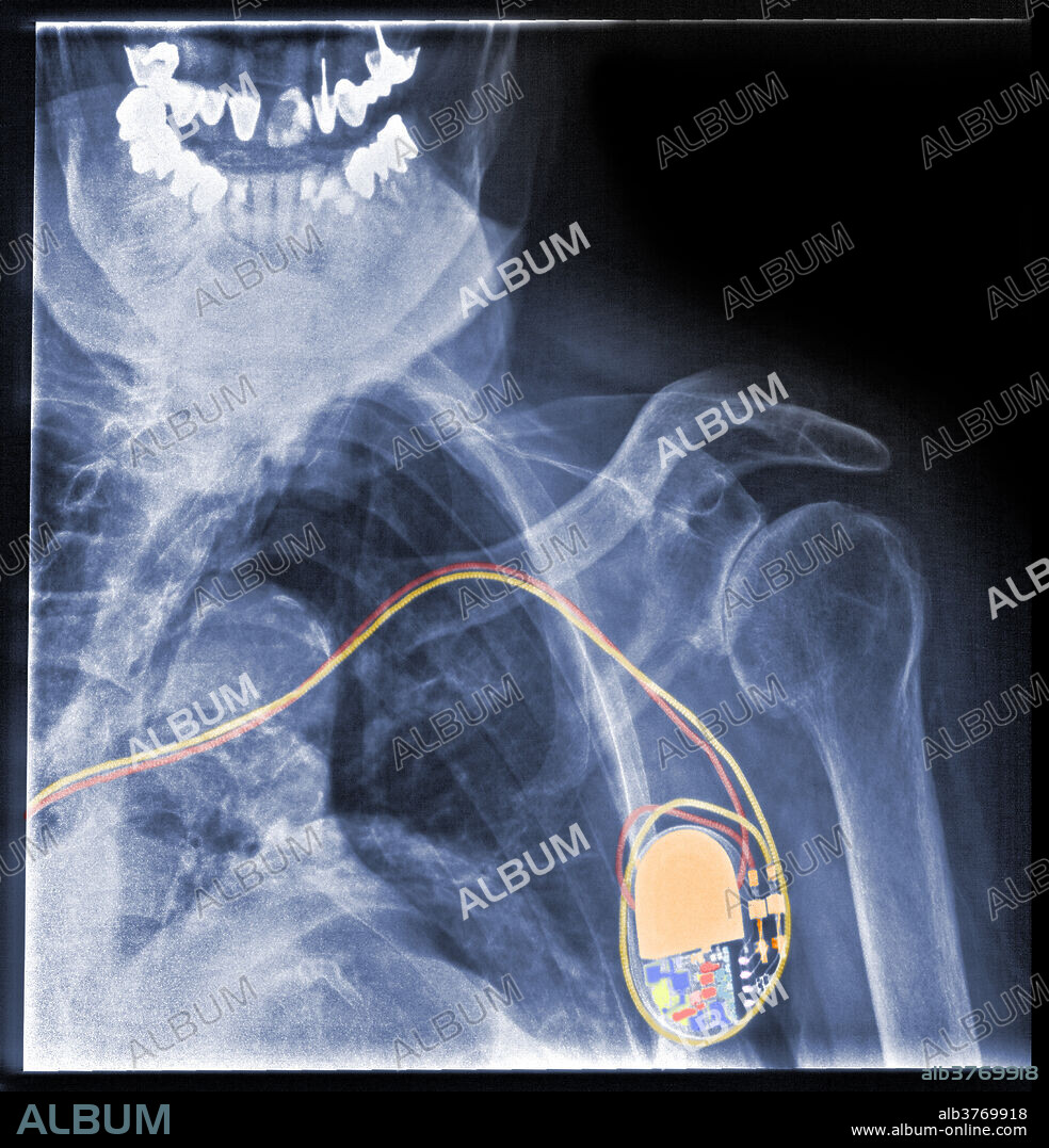 Color-enhanced x-ray of an implantable cardioverter-defibrillator (ICD), commonly known as a pacemaker. This is a small battery-powered electrical impulse generator which is implanted in patients who are at risk of sudden cardiac death due to ventricular fibrillation. The device is programmed to detect cardiac arrhythmia and correct it by delivering a jolt of electricity.