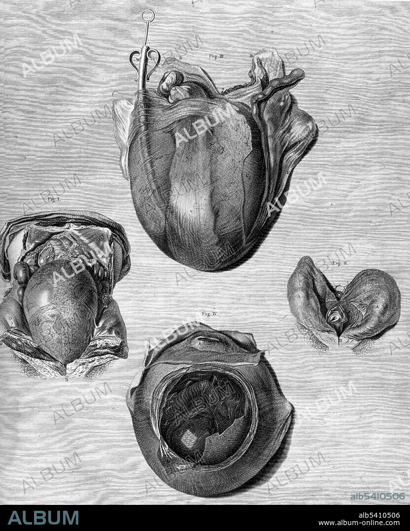 William Hunter's most famous work is the Anatomia uteri humani gravidi, or The anatomy of the human gravid uterus. In his preface, Hunter states that many of the drawings were first prepared in 1751. A majority of the drawings were executed by Jan van Rymsdyk, and a great number of engravers participated in the project. Printed at Birmingham by John Baskerville, 1774. Table 26. William Hunter (May 23, 1718 - March 30, 1783) was a Scottish anatomist and physician.
