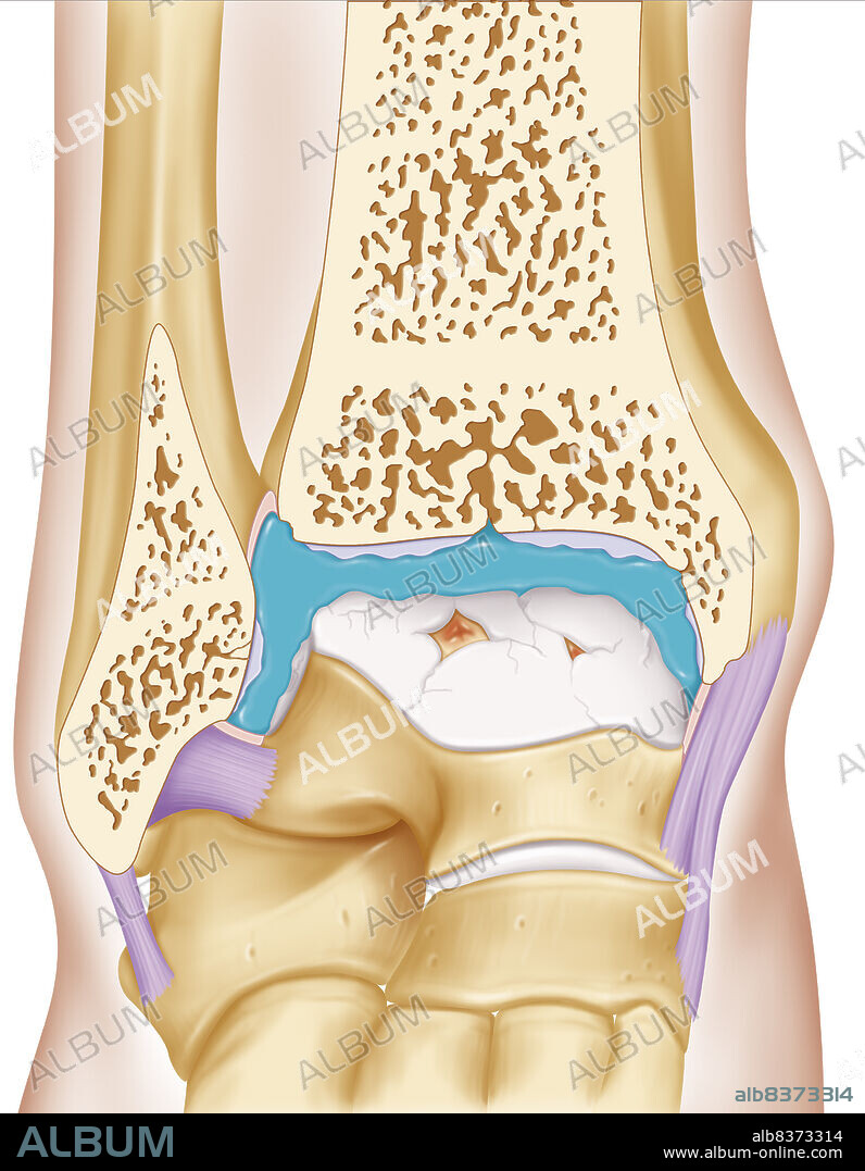Représentation du traitement de l'arthrose de la cheville, par injection de viscosupplément (bleu) dans l'articulation synoviale limitée par la membrane (rose). Ce liquide permet de restaurer l'espace articulaire entre les deux surfaces articulaires (épiphyses distales du tibia et du péroné et la poulie astragalienne).