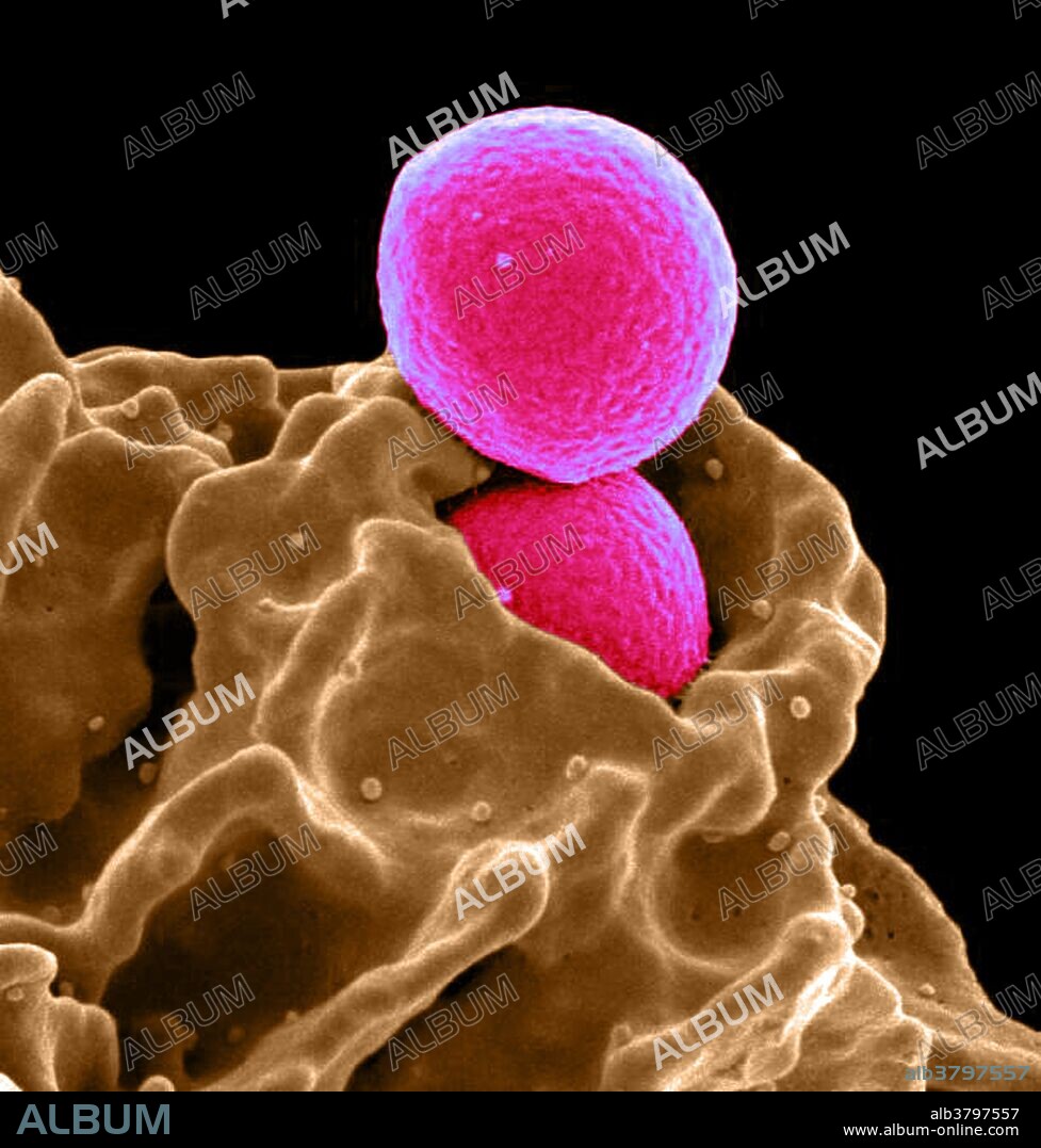 Color enhanced scanning electron micrograph of MRSA bacteria being ingested by a neutrophil. Methicillin-resistant Staphylococcus aureus (MRSA) is a bacterium responsible for several difficult-to-treat infections in humans. It is also called multidrug-resistant Staphylococcus aureus and oxacillin-resistant Staphylococcus aureus (ORSA). MRSA is any strain of Staphylococcus aureus that has developed resistance to beta-lactam antibiotics, which include penicillins and cephalosporins. Strains unable to resist these antibiotics are classified as methicillin-sensitive Staphylococcus aureus, or MSSA. The development of such resistance does not cause the organism to be more intrinsically virulent than strains of Staphylococcus aureus that have no antibiotic resistance, but resistance does make MRSA infection more difficult to treat with standard types of antibiotics and thus more dangerous. MRSA is especially troublesome in hospitals and nursing homes, where patients with open wounds, invasive devices, and weakened immune systems are at greater risk of infection than the general public.
