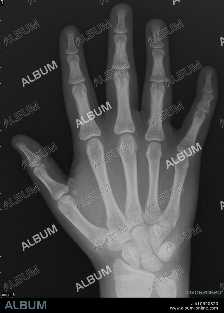 Normal AP frontal right hand X-ray in a 13 year old female.