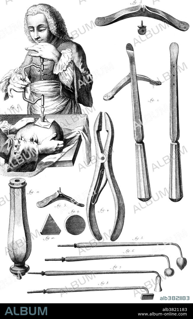 Trephining. In addition to forceps, instruments for actual cautery including a round and a triangular plate, a sleeve for different cauteries, and instruments designed by Petit and Louis, the surgical instrument arbre du trepan is demonstrated, 1772. Trepanning is a surgical intervention in which a hole is drilled or scraped into the human skull, exposing the dura mater to treat health problems related to intracranial diseases. Cave paintings indicate that people believed the practice would cure epileptic seizures, migraines, mental disorders and the bone that was trepanned was kept as a charm to keep evil spirits away. Trepanation was also practiced in the classical and Renaissance periods. Hippocrates gave specific directions on the procedure from its evolution through the Greek age, and Galen also elaborates on the procedure. During the Middle Ages and the Renaissance, trepanation was practiced as a cure for various ailments, including seizures and skull fractures.