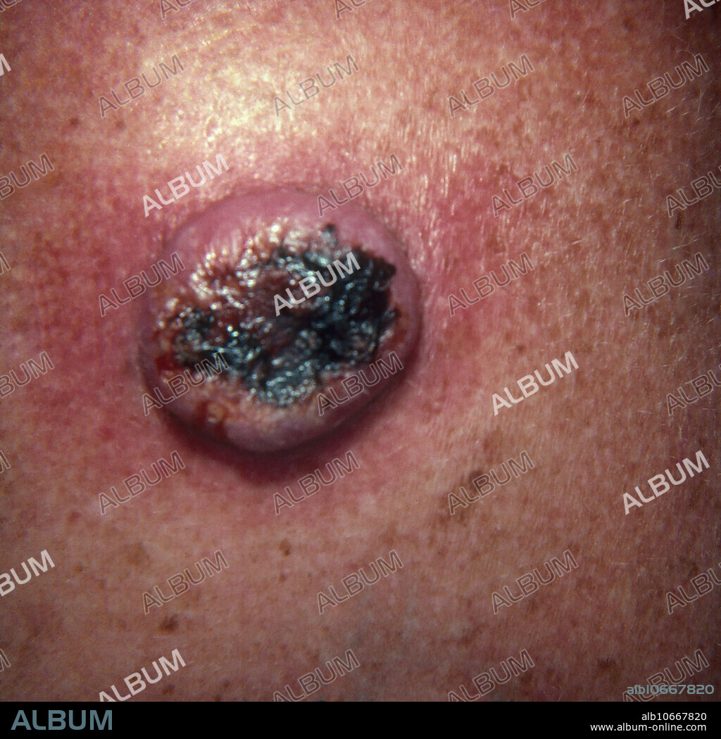 Squamous cell carcinoma of the keratoacanthoma type. Keratoacanthoma (KA) is a relatively common low-grade malignancy that originates in the pilosebaceous glands and closely and pathologically resembles squamous cell carcinoma (SCC).