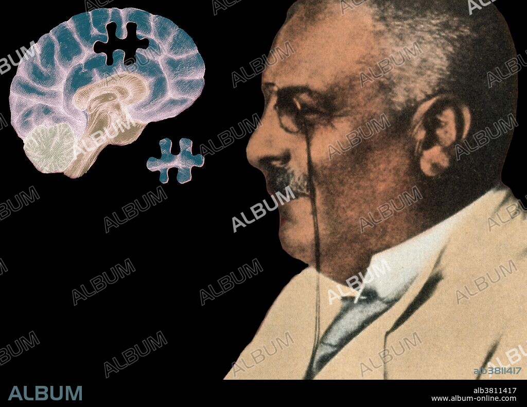 Alois Alzheimer (1864-1915). In 1906, German psychiatrist and neuropathologist Alois Alzheimer made a complete clinical and pathological description of presenile dementia, which came to be known as Alzheimer's disease, a progressive condition in which nerve cells in the brain degenerate. Inset image showing a brain with a piece missing, a conceptual illustration of Alzheimer's disease.