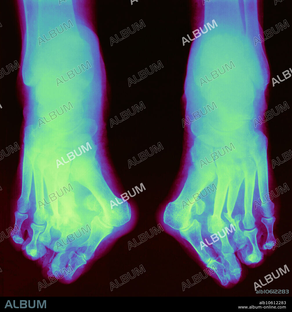 Colour enhanced x-ray showing an individual with Charcot's feet. Also known as neuropathic arthropathy, Charcot's joint is a joint disease characterized by degeneration of a joint beginning with loss of proprioceptive sensation resulting in bony destruction, bone resorption and deformity. Diabetes is a common cause of the disease.