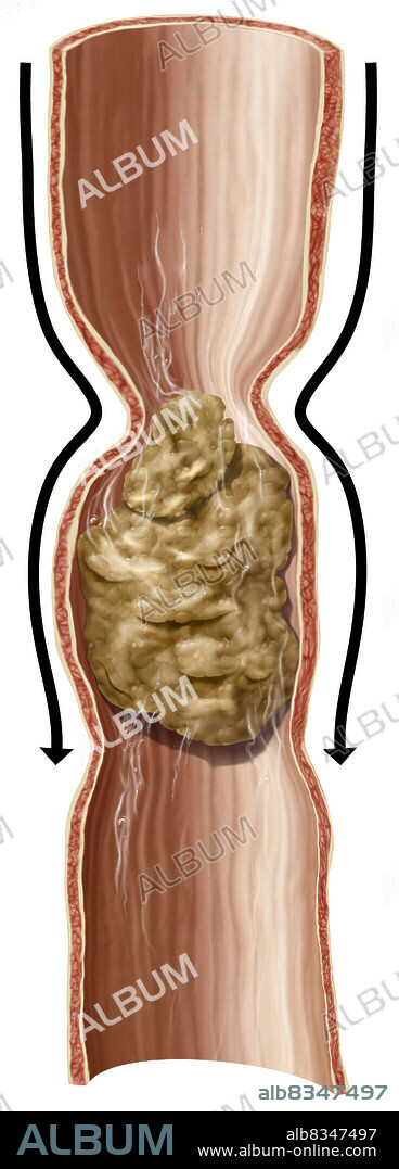 Peristalsis is an involuntary muscle contraction that propagates the length of a hollow organ (esophagus, stomach, small intestine, colon), under the effect of a stimulus, such as swallowing or filling the stomach or intestines. The speed of peristalsis varies depending on the organs.