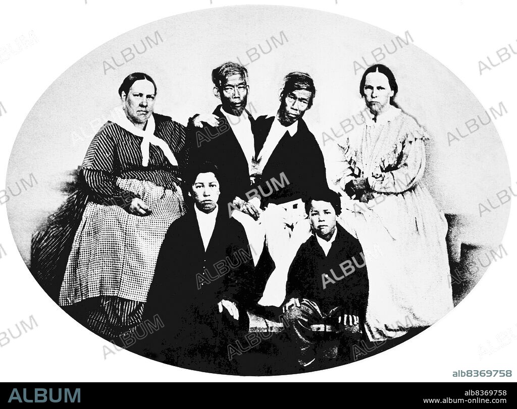 Chang and Eng Bunker (May 11, 1811 January 17, 1874) were Thai-American conjoined twin brothers whose condition and birthplace became the basis for the term 'Siamese twins'.<br/><br/>. The Bunker brothers were born on May 11, 1811, in the province of Samutsongkram, near Bangkok, in the Kingdom of Siam (today's Thailand). Their fisherman father was a Chinese Thai, while their mother was a Chinese Malaysian. Because of their Chinese heritage, they were known locally as the 'Chinese Twins'. The brothers were joined at the sternum by a small piece of cartilage, and though their livers were fused, they were independently complete.<br/><br/>. In 1829, Robert Hunter, a Scottish merchant who lived in Bangkok, saw the twins swimming and realized their potential. He paid their parents to permit him to exhibit their sons as a curiosity on a world tour. When their contract with Hunter was over, Chang and Eng went into business for themselves. In 1839, while visiting Wilkesboro, North Carolina, the brothers were attracted to the area and purchased a 110-acre (0.45 km2) farm in nearby Traphill.<br/><br/>. Determined to live as normal a life they could, Chang and Eng settled on their small plantation and bought slaves to do the work they could not do themselves. Using their adopted name 'Bunker', they married local women on April 13, 1843. Chang wed Adelaide Yates, while Eng married her sister, Sarah Anne. Chang and Adelaide would become the parents of eleven children. Eng and Sarah had ten. The twins also became naturalized American citizens.<br/><br/>. On January 17, 1874, Chang died while the brothers were asleep. Eng awoke to find his brother dead and cried, 'Then I am going'. A doctor was summoned to perform an emergency separation, but he was too late. Eng died approximately three hours later.