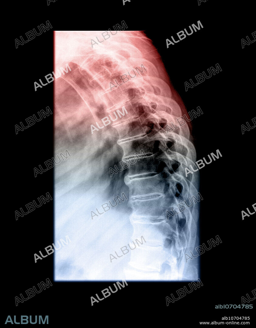 This enhanced lateral x-ray of the thoracic spine demonstrates multilevel degenerative changes with disc space narrowing and multilevel vertebral margin osteophytes. Osteoporosis is noted.