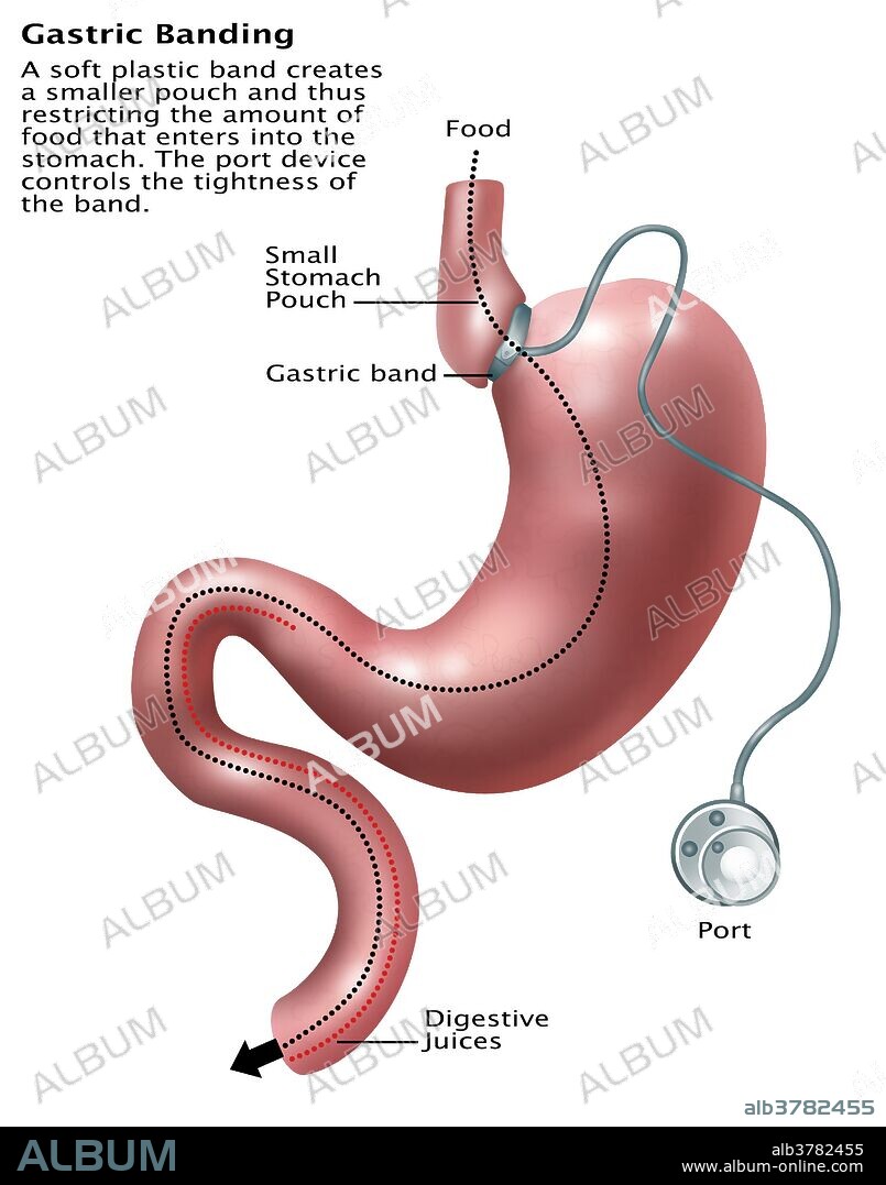 Illustration of gastric banding. A laparoscopic adjustable gastric band, commonly called a lap-band, A band, or LAGB, is an inflatable silicone device placed around the top portion of the stomach to treat obesity, intended to slow consumption of food and thus reduce the amount of food consumed. A soft plastic band creates a smaller pouch, thus restricting the amount of food that enters into the stomach. The port device controls the tightness of the band.