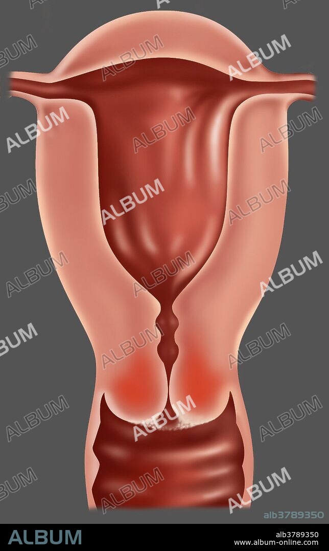 Medical illustration showing early stage IB of cervical cancer. This stage is defined by clinically visible lesions, less than 4 centimeters across the greatest dimension, limited to the cervix uteri. Symptoms of cervical cancer include bleeding between periods, pain after sexual intercourse and heavier periods. Cancer of the cervix is rare and if detected early is almost always cured.