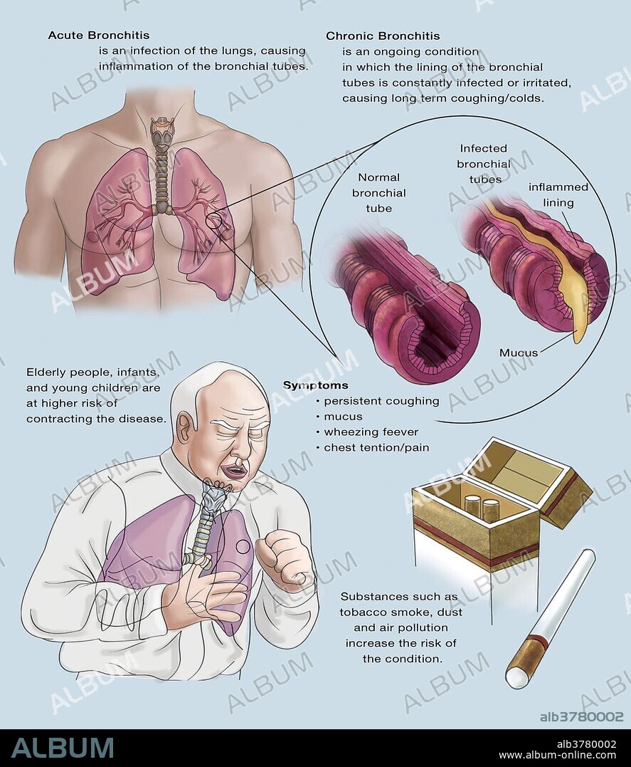 Illustrated pamphlet about acute and chronic bronchitis. Acute Bronchitis is an infection of the lungs, causing inflammation of the bronchial tubes. Chronic bronchitis is an ongoing condition in which the lining of the bronchial tubes is constantly infected or irritated causing long term coughing or colds.