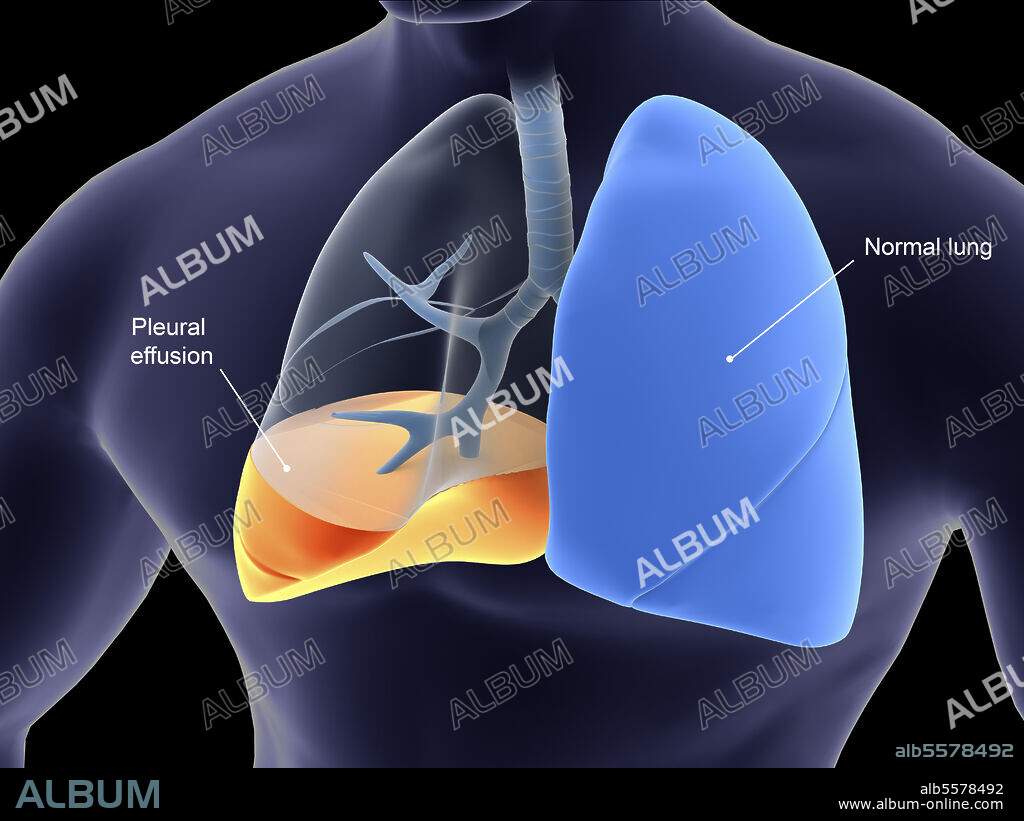 Medical illustration showing pleurisy. Pleurisy is inflammation of membranes that surround the human lungs.