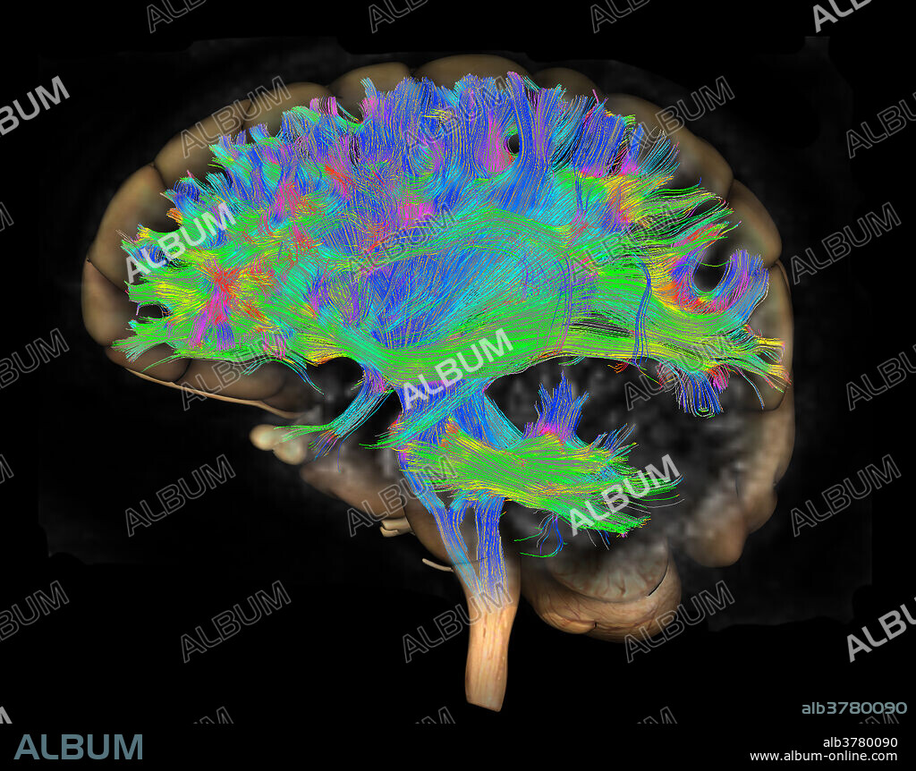 Diffusion MRI, also referred to as diffusion tensor imaging or DTI, of the human brain. In neuroscience, tractography is a 3D modelling technique used to visually represent neural tracts using data collected by diffusion tensor imaging (DTI). It uses special techniques of magnetic resonance imaging (MRI), and computer-based image analysis.