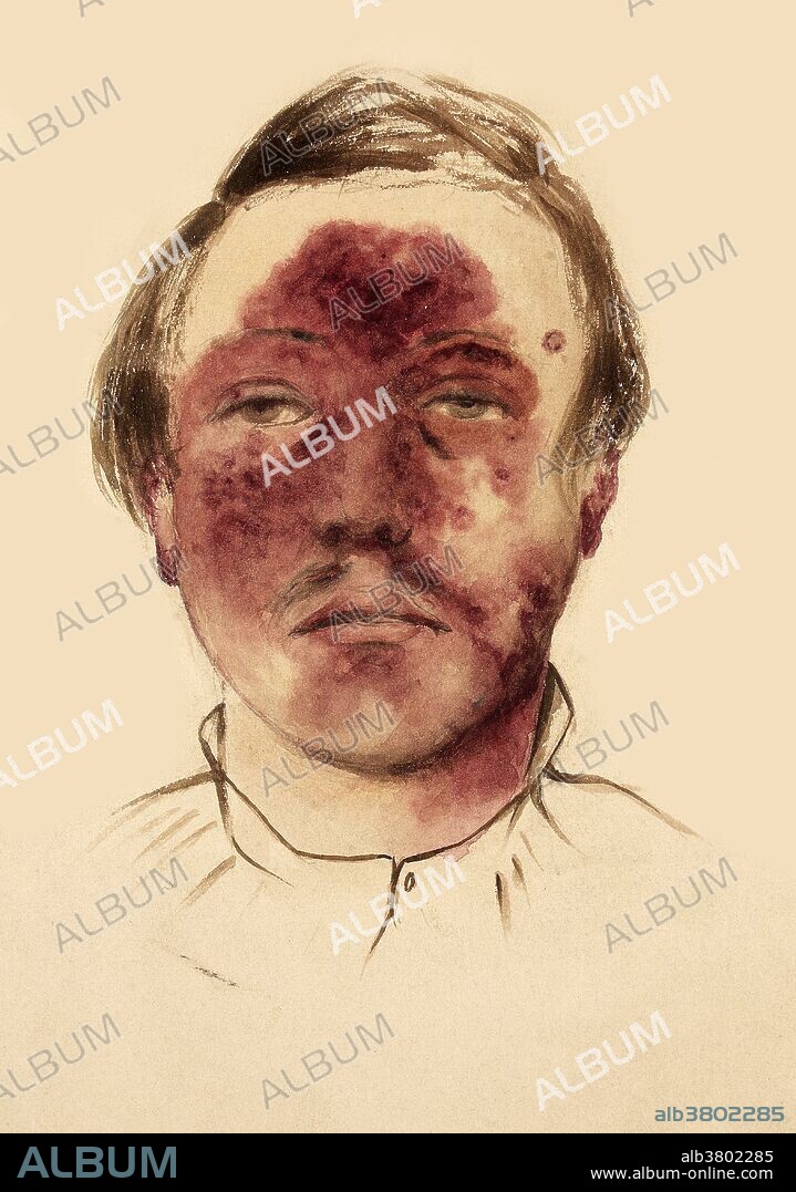 Watercolor drawing of a probable case of erythema multiforme on the face of a male patient. Includes sketch detail of the skin lesions associated with condition. Thomas Godart, c. 1880. Erythema multiforme (EM) is an acute, self-limited, and sometimes recurring skin condition that is considered to be a type IV hypersensitivity reaction associated with certain infections, medications, and other various triggers.